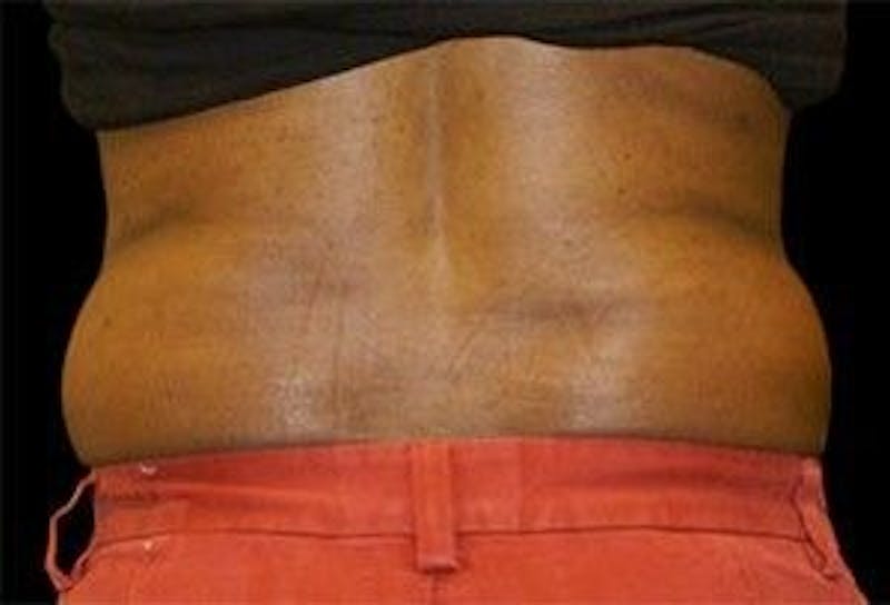 CoolSculpting Before & After Gallery - Patient 55344904 - Image 1
