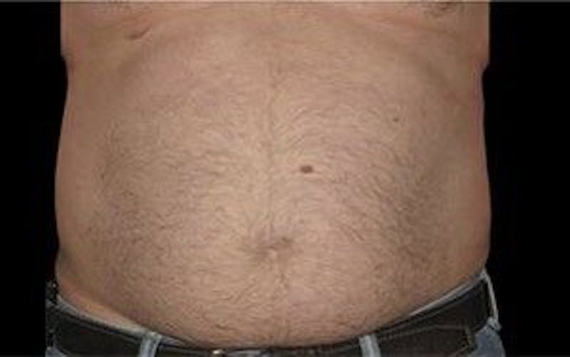 CoolSculpting Before & After Gallery - Patient 55344908 - Image 1