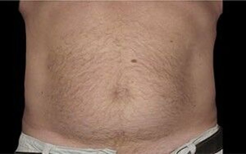CoolSculpting Before & After Gallery - Patient 55344908 - Image 2