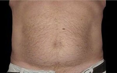 CoolSculpting Before & After Gallery - Patient 55344908 - Image 2