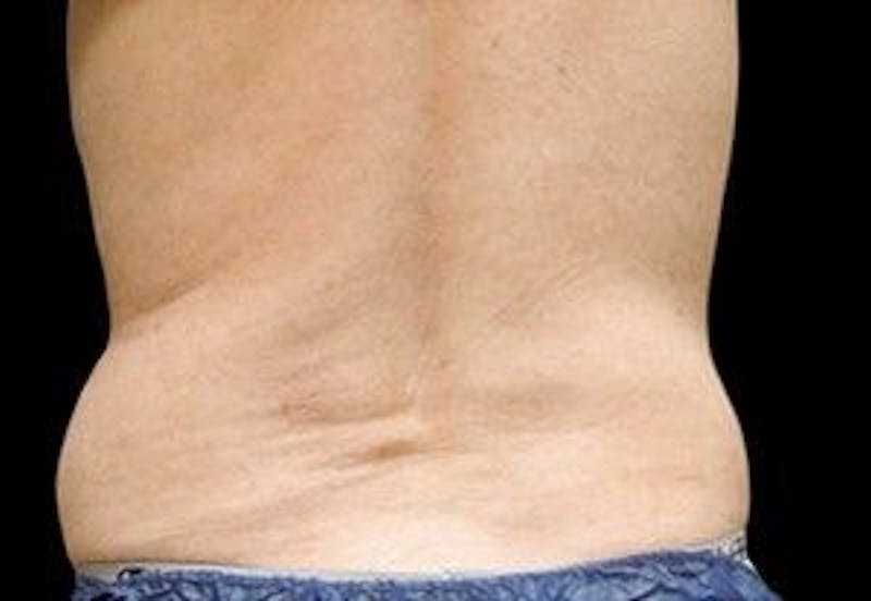 CoolSculpting Before & After Gallery - Patient 55344909 - Image 1