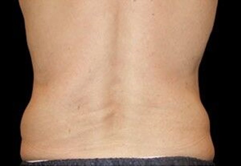 CoolSculpting Before & After Gallery - Patient 55344909 - Image 2