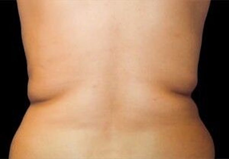 CoolSculpting Before & After Gallery - Patient 55344916 - Image 1