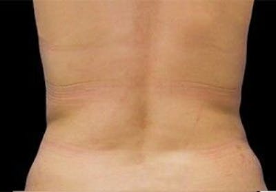 CoolSculpting Before & After Gallery - Patient 55344916 - Image 2
