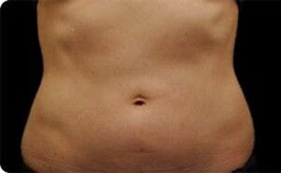 CoolSculpting Before & After Gallery - Patient 55344919 - Image 1