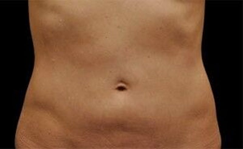 CoolSculpting Before & After Gallery - Patient 55344919 - Image 2