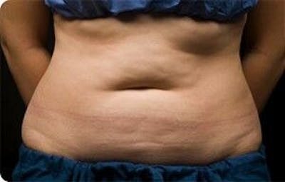 CoolSculpting Before & After Gallery - Patient 55344921 - Image 1