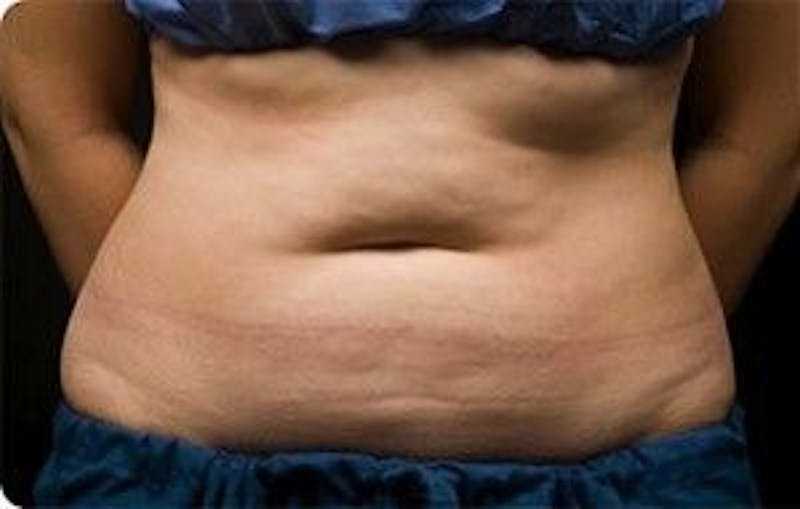 CoolSculpting Before & After Gallery - Patient 55344921 - Image 1