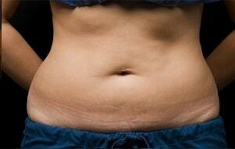 CoolSculpting Before & After Gallery - Patient 55344921 - Image 2