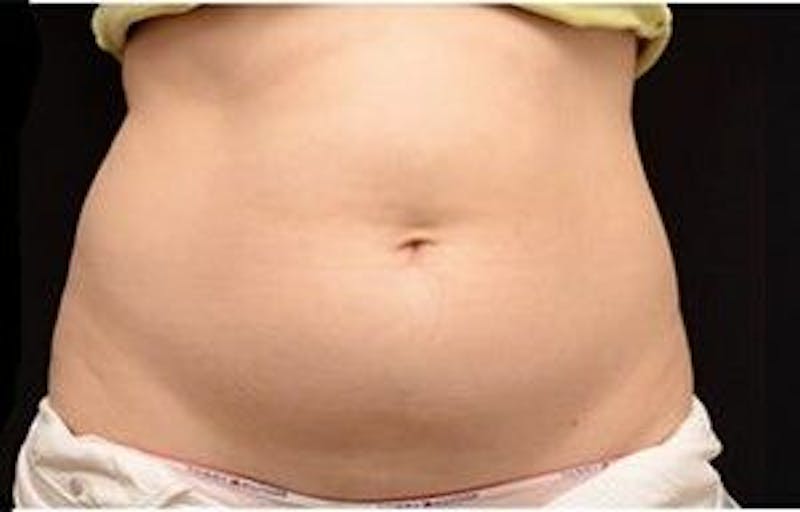 CoolSculpting Before & After Gallery - Patient 55344923 - Image 1