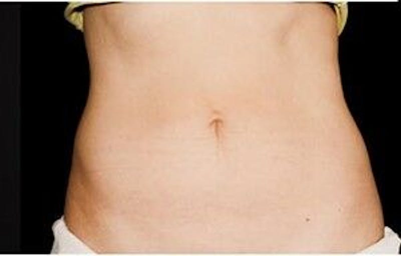 CoolSculpting Before & After Gallery - Patient 55344923 - Image 2