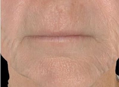 Infini Genius Before & After Gallery - Patient 55344924 - Image 2