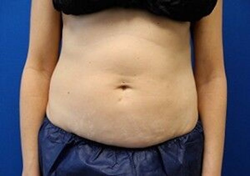 CoolSculpting Before & After Gallery - Patient 55344926 - Image 1