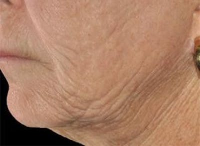 Infini Genius Before & After Gallery - Patient 55344925 - Image 1