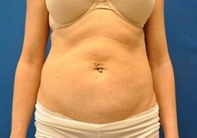 CoolSculpting Before & After Gallery - Patient 55344926 - Image 2