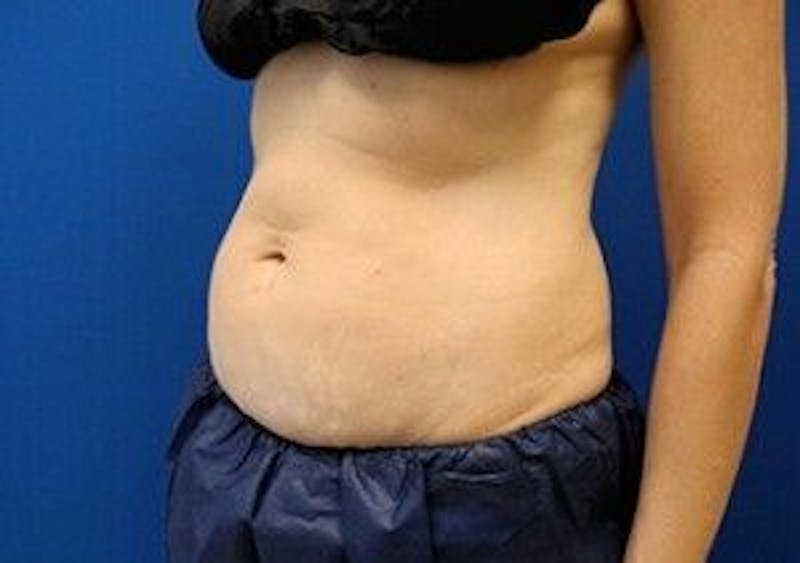 CoolSculpting Before & After Gallery - Patient 55344926 - Image 3