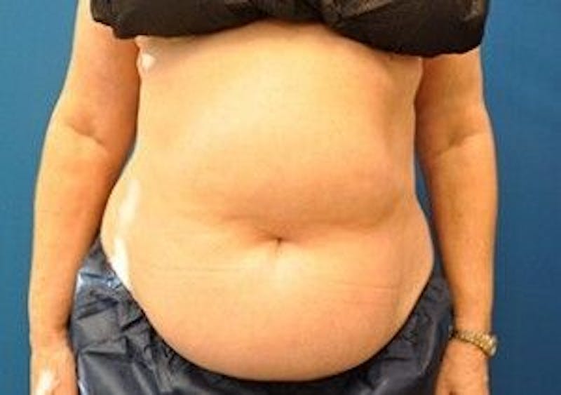 CoolSculpting Before & After Gallery - Patient 55344929 - Image 1