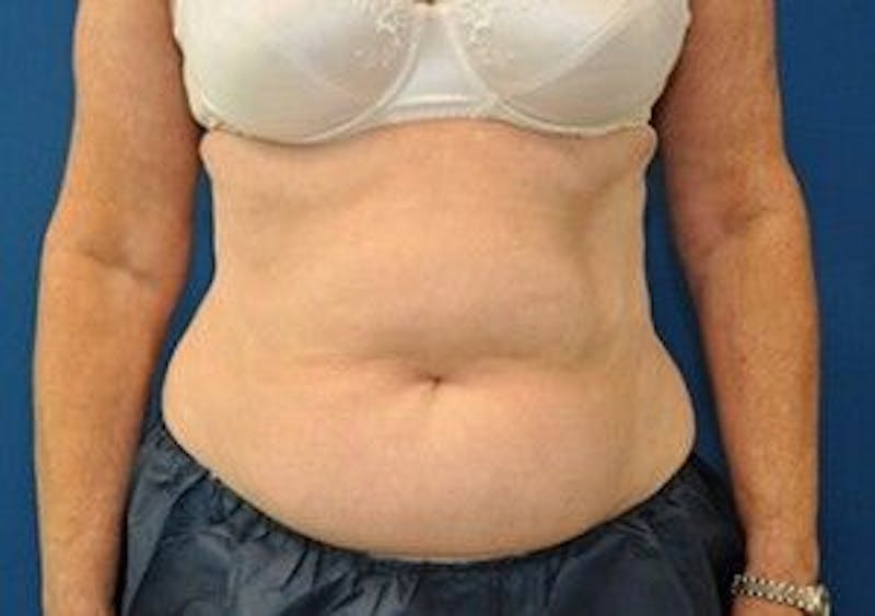 CoolSculpting Before & After Gallery - Patient 55344929 - Image 2