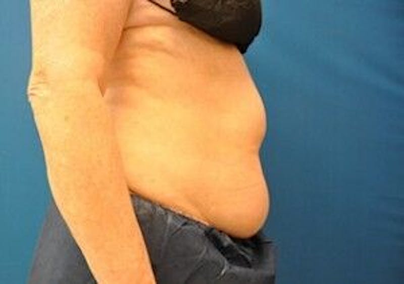 CoolSculpting Before & After Gallery - Patient 55344929 - Image 3