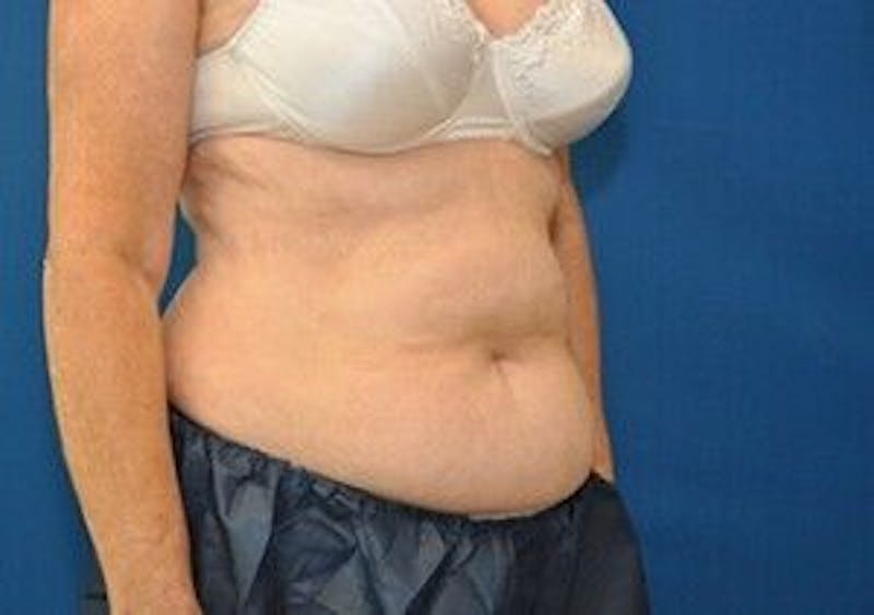 CoolSculpting Before & After Gallery - Patient 55344929 - Image 4