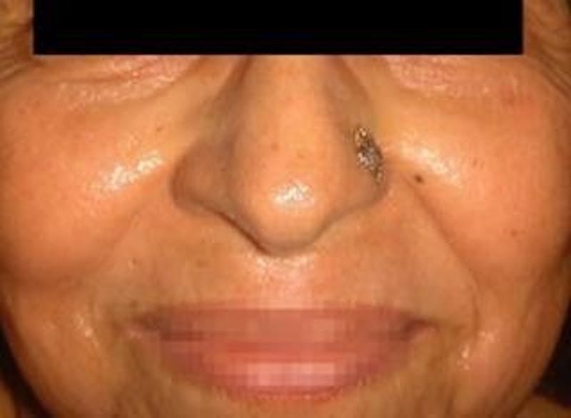 Infini Genius Before & After Gallery - Patient 55344930 - Image 2