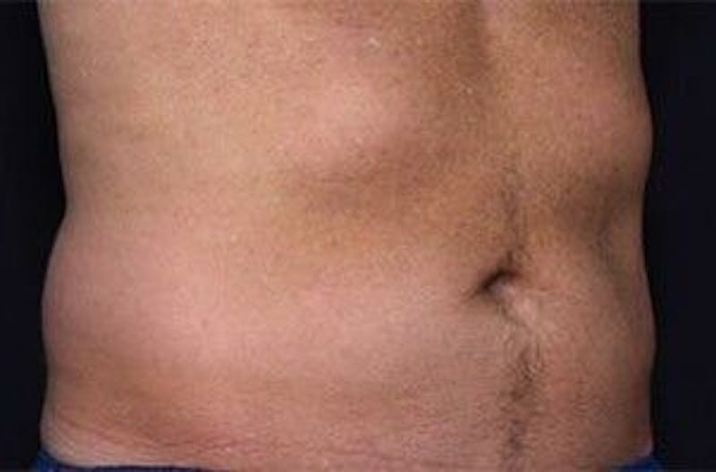 CoolSculpting Before & After Gallery - Patient 55344932 - Image 1