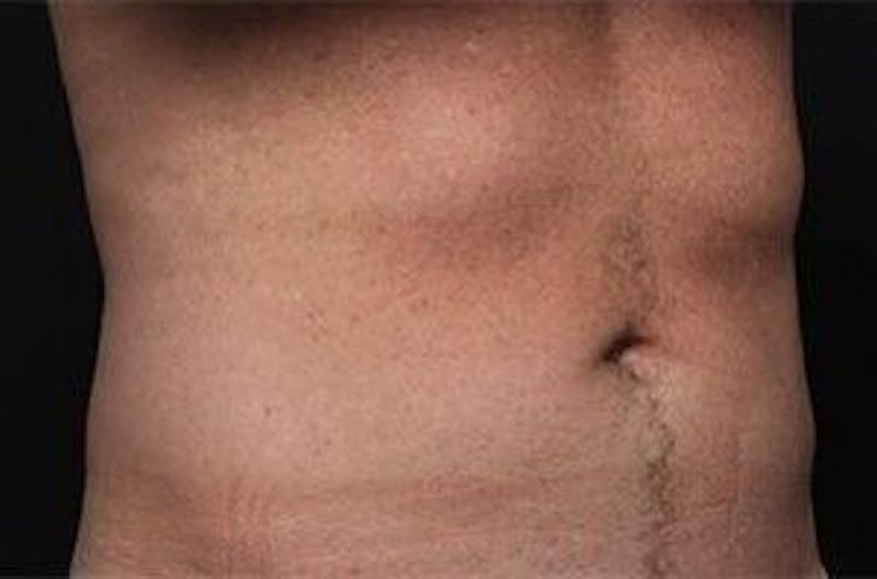 CoolSculpting Before & After Gallery - Patient 55344932 - Image 2