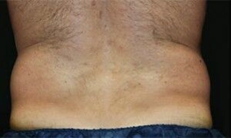 CoolSculpting Before & After Gallery - Patient 55344932 - Image 3