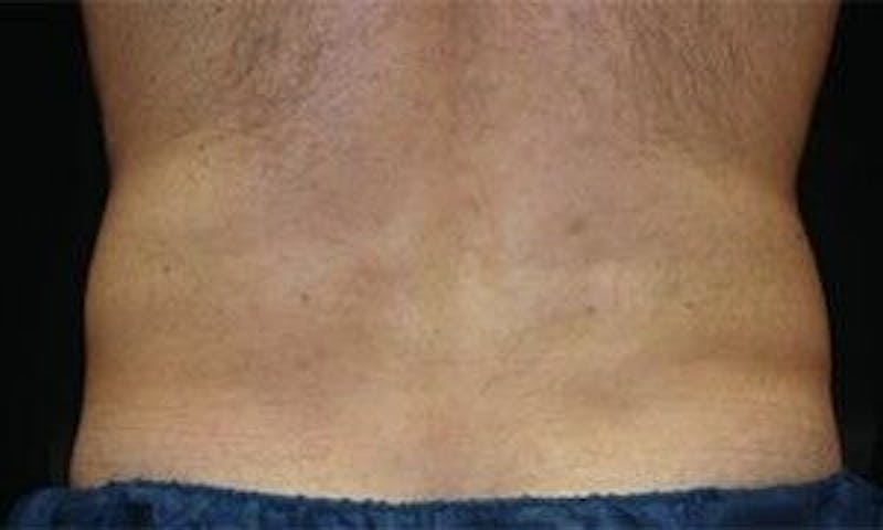 CoolSculpting Before & After Gallery - Patient 55344932 - Image 4