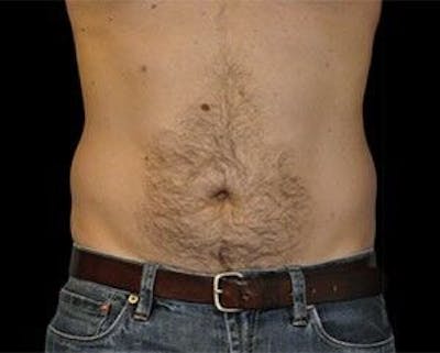 CoolSculpting Before & After Gallery - Patient 55344936 - Image 1