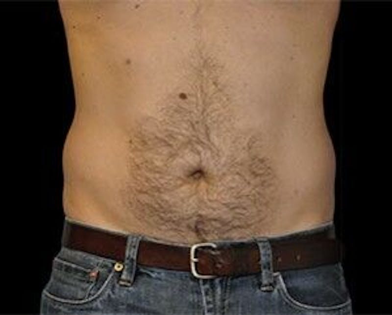 CoolSculpting Before & After Gallery - Patient 55344936 - Image 1