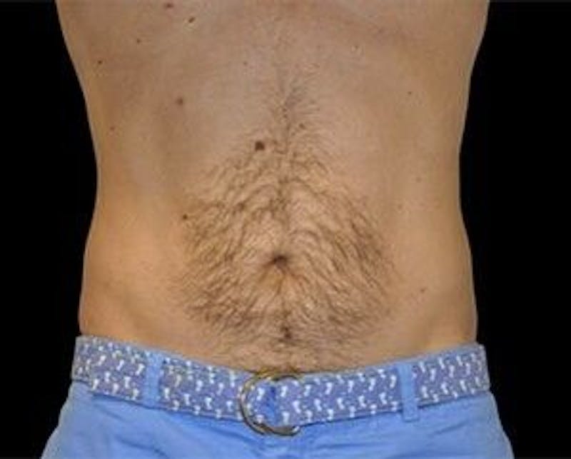 CoolSculpting Before & After Gallery - Patient 55344936 - Image 2