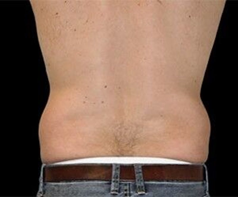 CoolSculpting Before & After Gallery - Patient 55344936 - Image 3