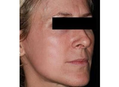 Infini Genius Before & After Gallery - Patient 55344934 - Image 2