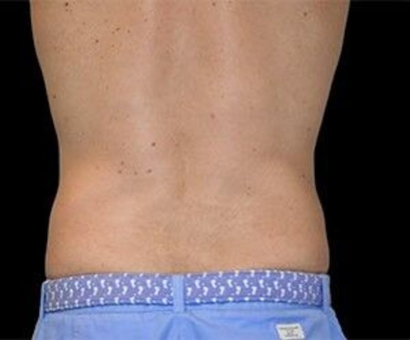 CoolSculpting Before & After Gallery - Patient 55344936 - Image 4