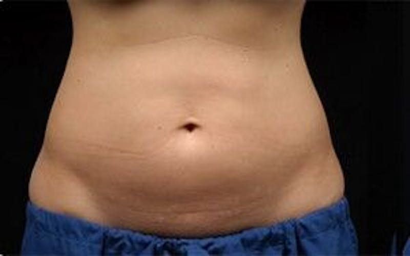 CoolSculpting Before & After Gallery - Patient 55344939 - Image 1