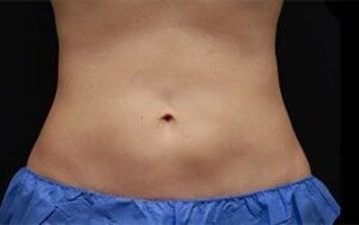 CoolSculpting Before & After Gallery - Patient 55344939 - Image 2