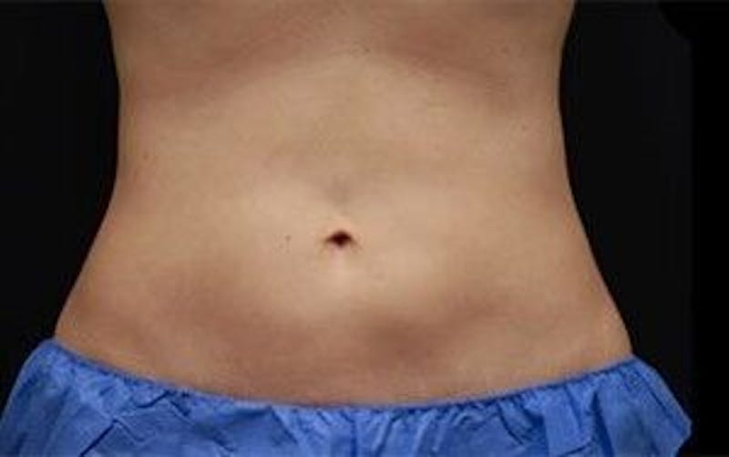 CoolSculpting Before & After Gallery - Patient 55344939 - Image 2
