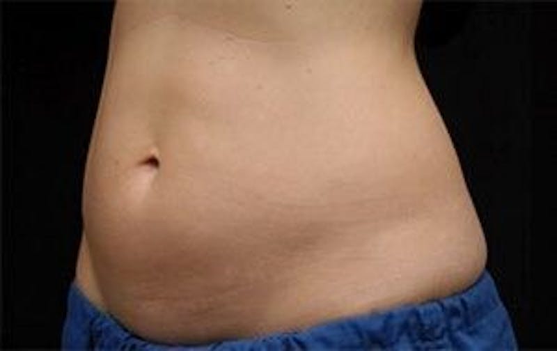 CoolSculpting Before & After Gallery - Patient 55344939 - Image 3