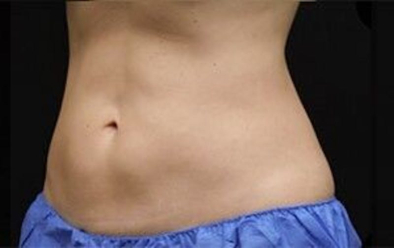 CoolSculpting Before & After Gallery - Patient 55344939 - Image 4