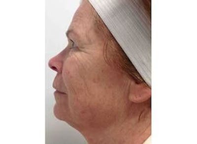 Infini Genius Before & After Gallery - Patient 55344940 - Image 1