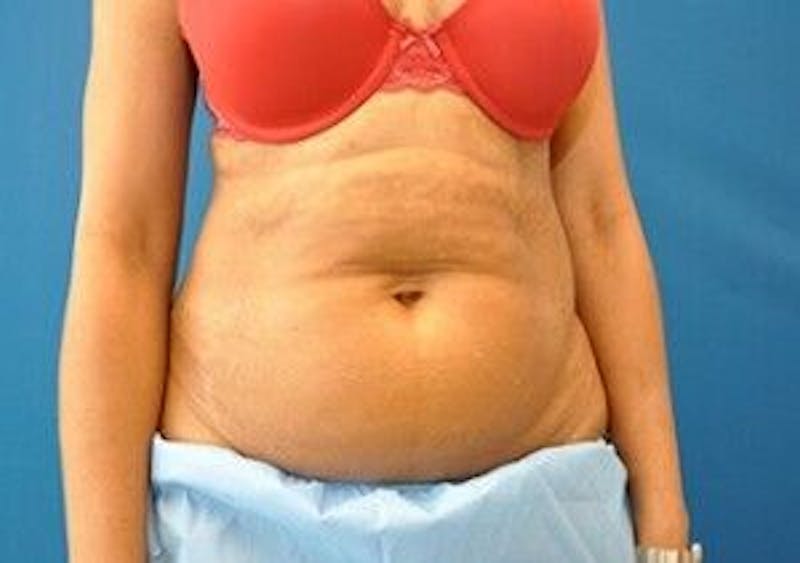 CoolSculpting Before & After Gallery - Patient 55344942 - Image 1