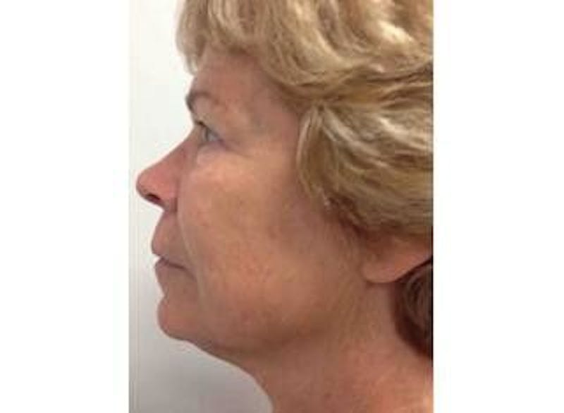 Infini Genius Before & After Gallery - Patient 55344940 - Image 2