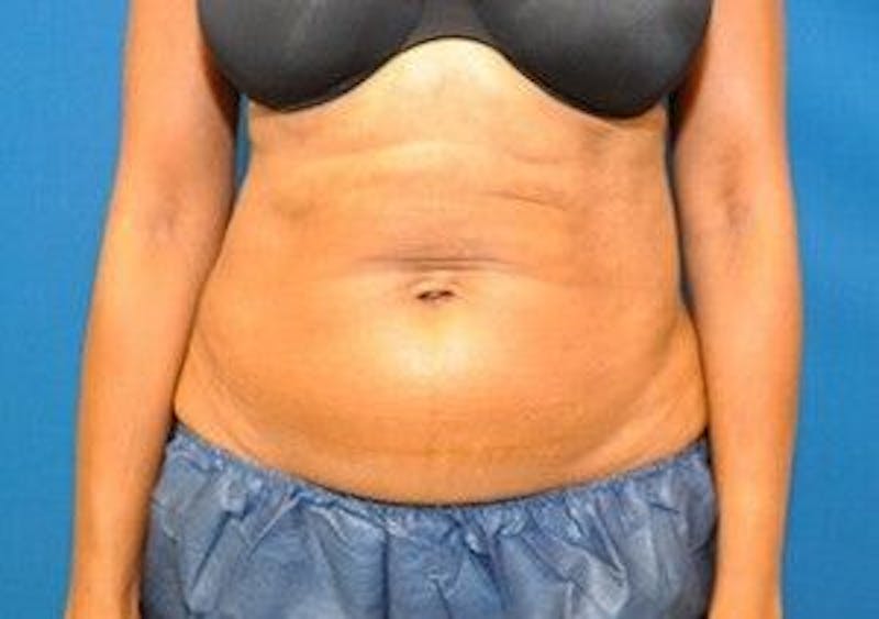 CoolSculpting Before & After Gallery - Patient 55344942 - Image 2
