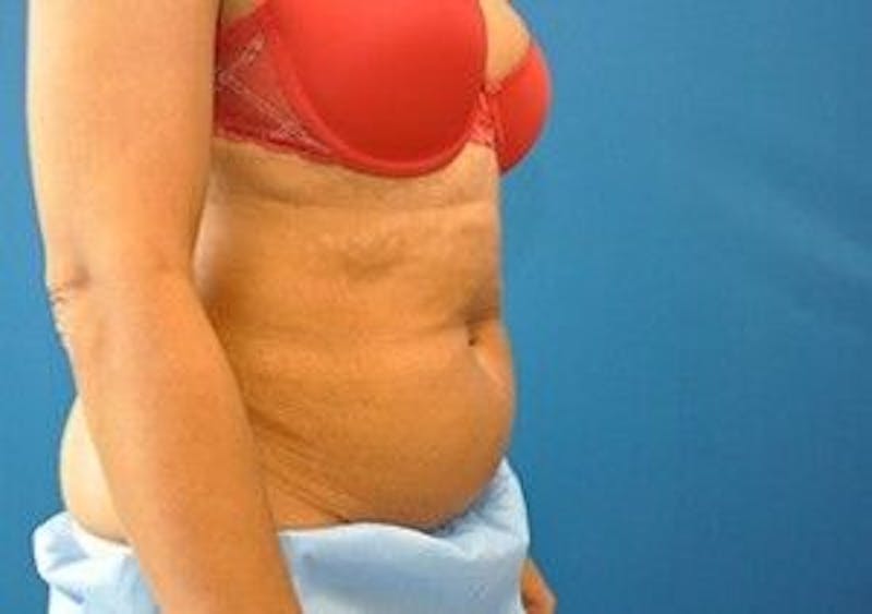 CoolSculpting Before & After Gallery - Patient 55344942 - Image 3