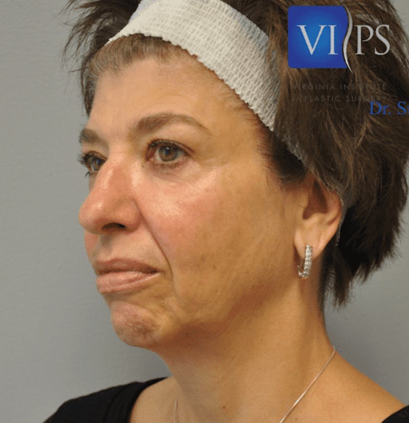 Infini Genius Before & After Gallery - Patient 55344941 - Image 1