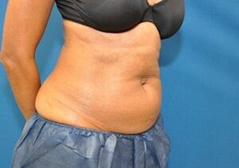 CoolSculpting Before & After Gallery - Patient 55344942 - Image 4