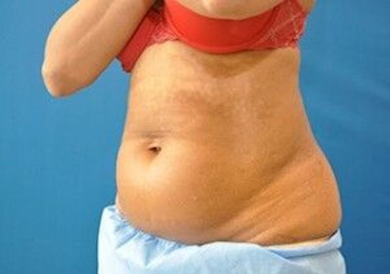 CoolSculpting Before & After Gallery - Patient 55344942 - Image 5