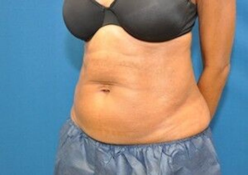 CoolSculpting Before & After Gallery - Patient 55344942 - Image 6