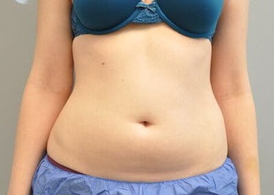 CoolSculpting Before & After Gallery - Patient 55344961 - Image 1